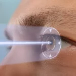 Laser Eye Surgery